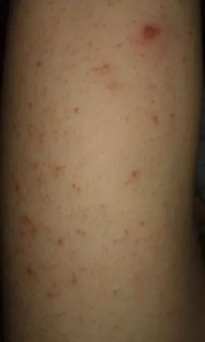 大腿上长痘痘是怎么回事(如图),不痛不痒,已经好几年了,短裤都不敢穿.