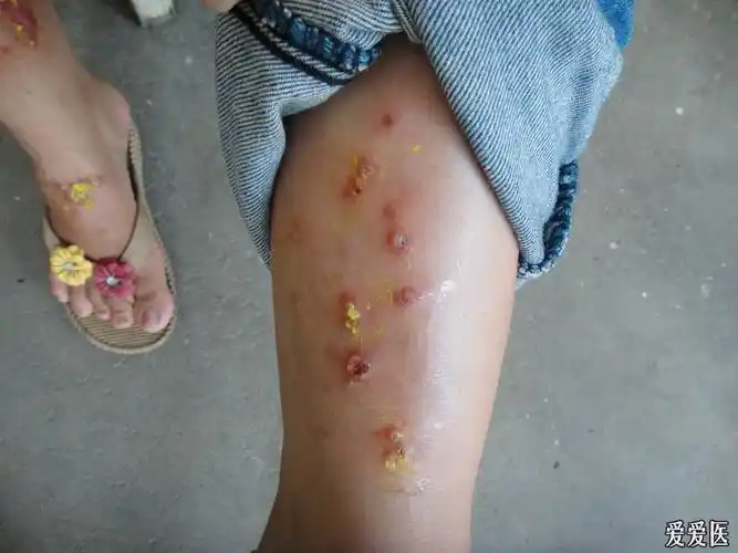 看图诊断47自身敏感性皮炎图片上传停止