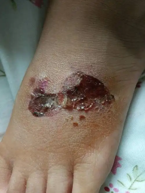 五岁小孩吃稀饭把脚背烫伤,第一天起泡不大,第四天长大很多去医院把