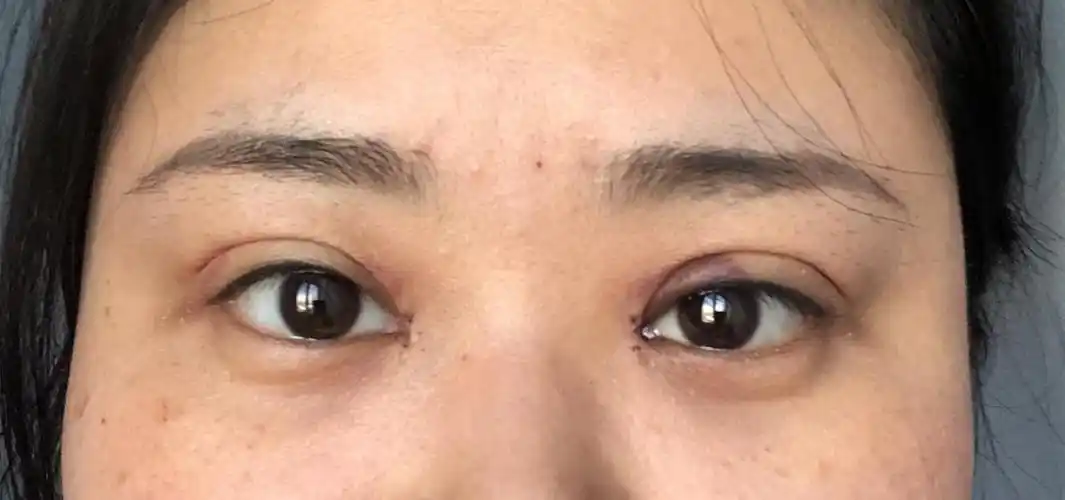 130手术姐妹们帮忙看看提肌是不是失败了北京镭射双眼皮提肌去脂切开