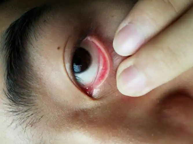 下眼皮内侧有一个小白点,不知道是什么原因,请问有没有什么问题