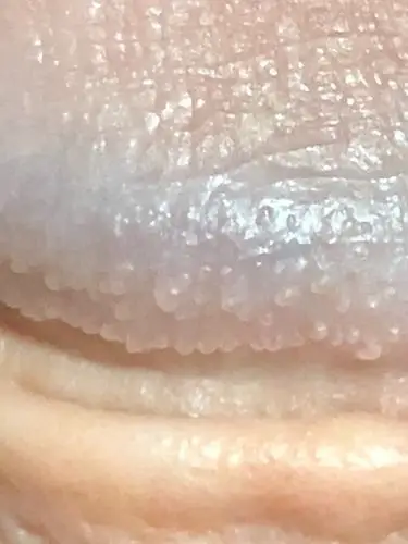 珍珠样丘疹:我很丑,但我很温柔