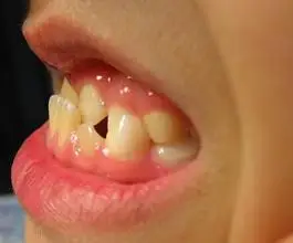 地包天矫正如何进行