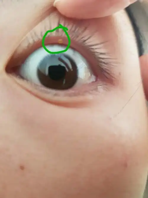慎入 眼睑的地方长了黄色的水泡?有姐妹知道怎么办吗