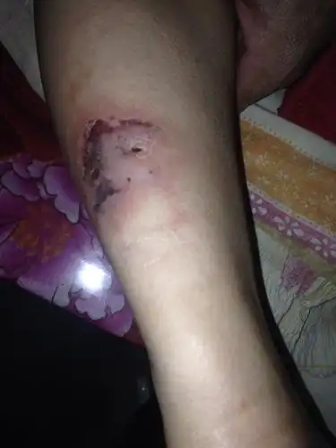 我妈被蜘蛛咬了半个月都不好,肉里面非常痛,感觉外面都坏了,大家有