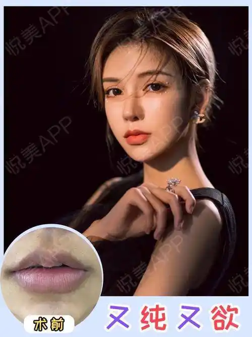案例分享|上唇m唇 嘴角上扬|术后一年_悦美整形