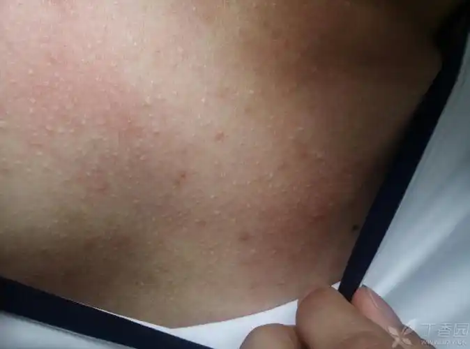 求大家看看胸前这些白色小泡是什么,会传染吗 2016-06-15 09:15