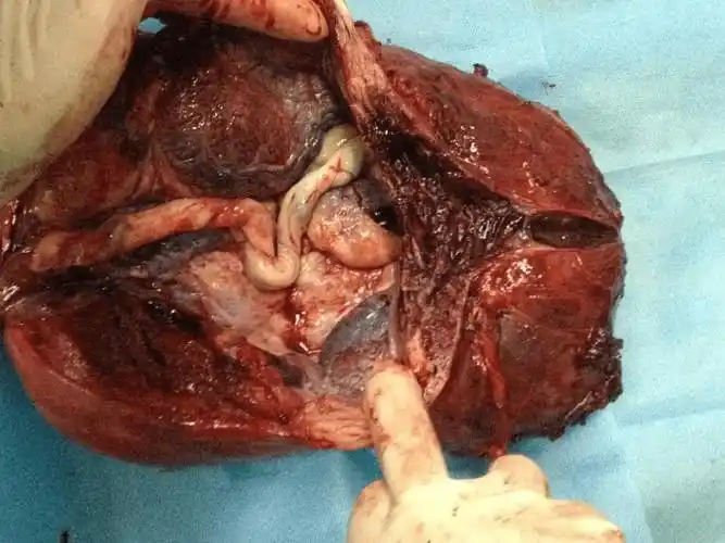 凶险性前置胎盘诊治