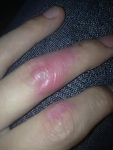 手被烫伤怎么办 手被烫伤怎么办消肿止痛