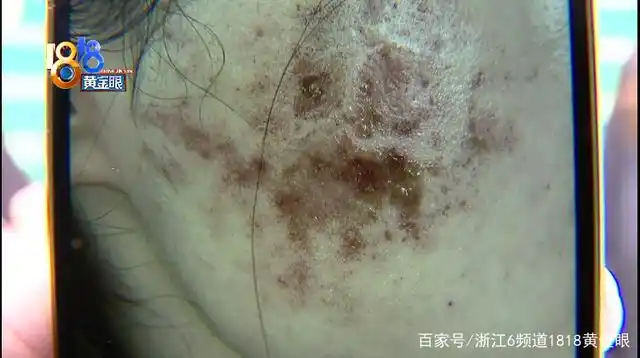 小游姑娘在美容机构做了"光子嫩肤",说是做完之后,脸上起水泡,还结痂