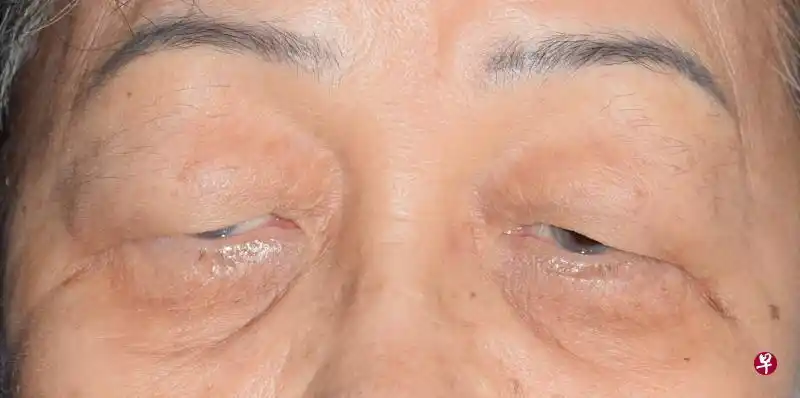 "眼科常见疾病"系列二 难以预防老年性上眼睑下垂