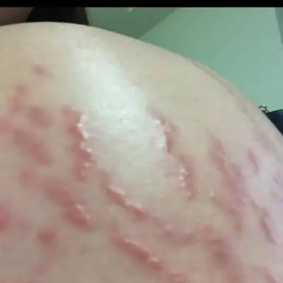 肚皮上妊娠纹长这种红疙瘩,痒的时候特别痒,不知道这是什麼,对胎儿有