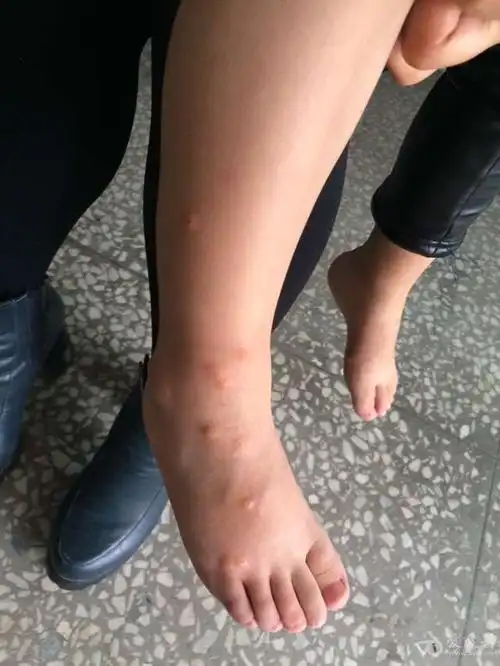 虫咬性皮炎的治疗