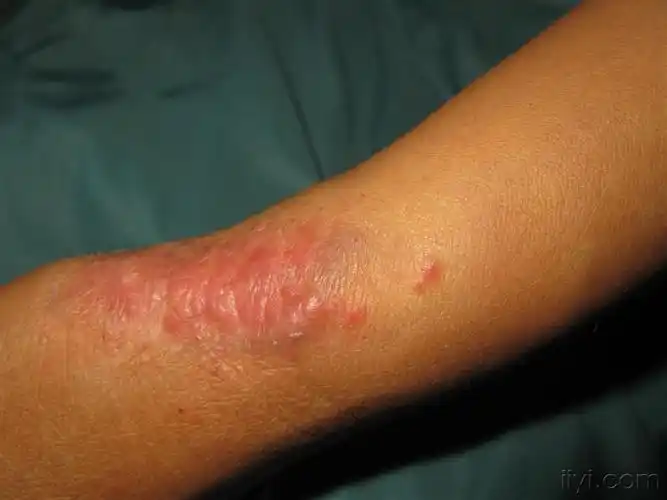 看图识病左臂线状丘疹