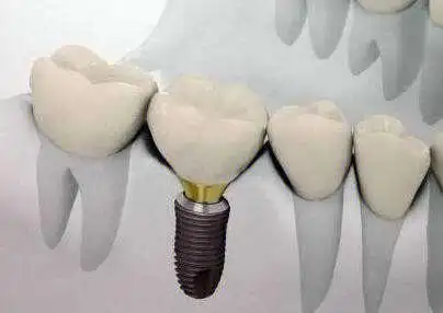 种植牙到底可以用多长时间