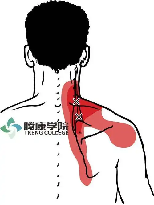 肌肉疗法|肩胛提肌损伤_手机搜狐网