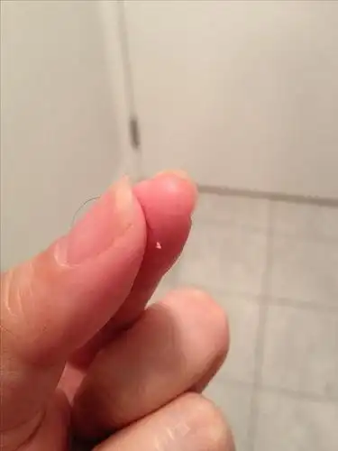 【求助】脱落头发的发根有白色固体?还有救吗?有图