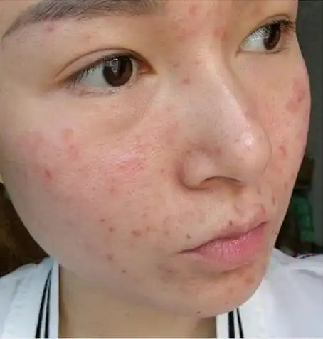 从上学到工作,多年以来经常被别人称之为:麻子脸,痘花脸,花脸猫,豆花