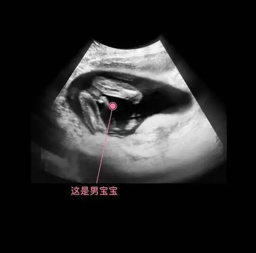 胎儿从卵泡到孕17周,17张图片清晰诠释,男宝女宝看得很清楚