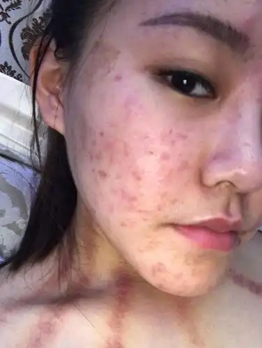 我的毛囊炎用外洗加涂抹的中药方好了分享经验希望对大家有用