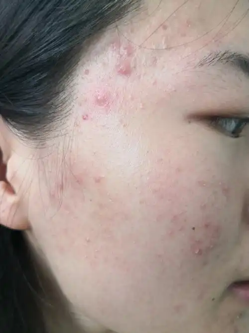 解决皮肤问题专注皮肤美容##痤疮##马拉色菌毛囊炎