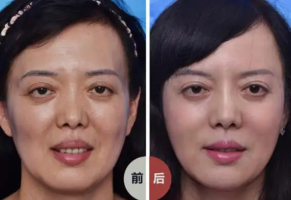 自体脂肪填充面部,有哪些效果,适合哪些人呢?还有哪些注意事项