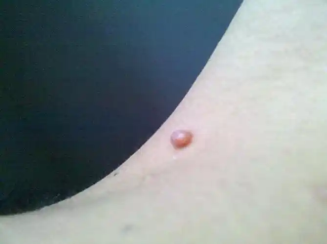 身上出了一些这样的痘痘,请懂医的帮我看看这是什么,需要怎样治疗吗?