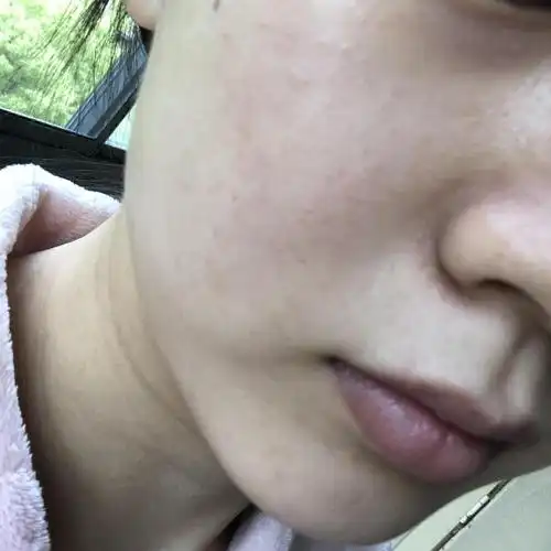 毛孔粗大且泛红,能用清洁毛孔和美白淡斑的产品吗?