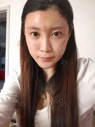 是谁抢我小熊自体脂肪全脸填充第1天美丽日记