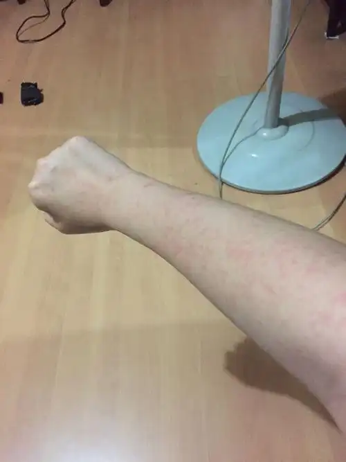 图是洗了澡后拍的 会痒 洗了不痒些 是皮肤过敏什么的症状吗 有半年了