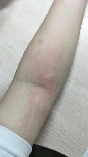 友友们这是蚊子咬的包么可能要加个慎入