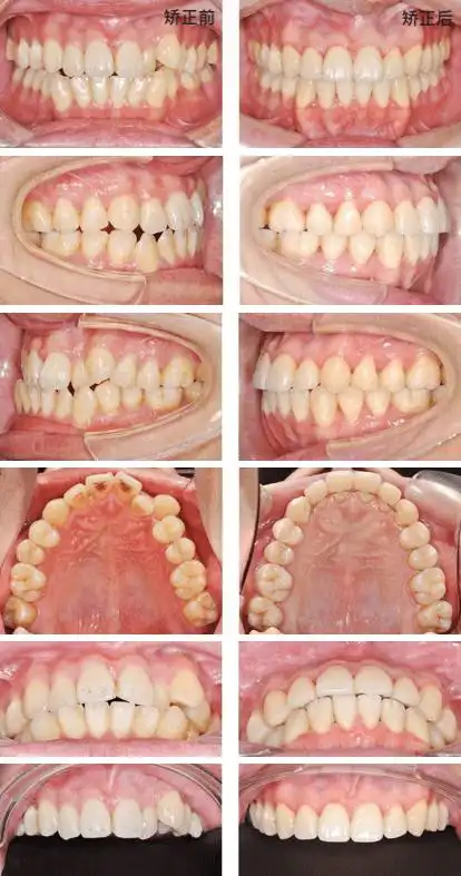 虎牙対刃拥挤,19个月地包天男孩重获自信笑容