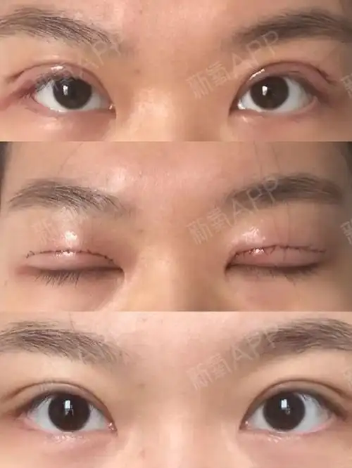 有求美者问7毫米的双眼皮宽度合适吗?