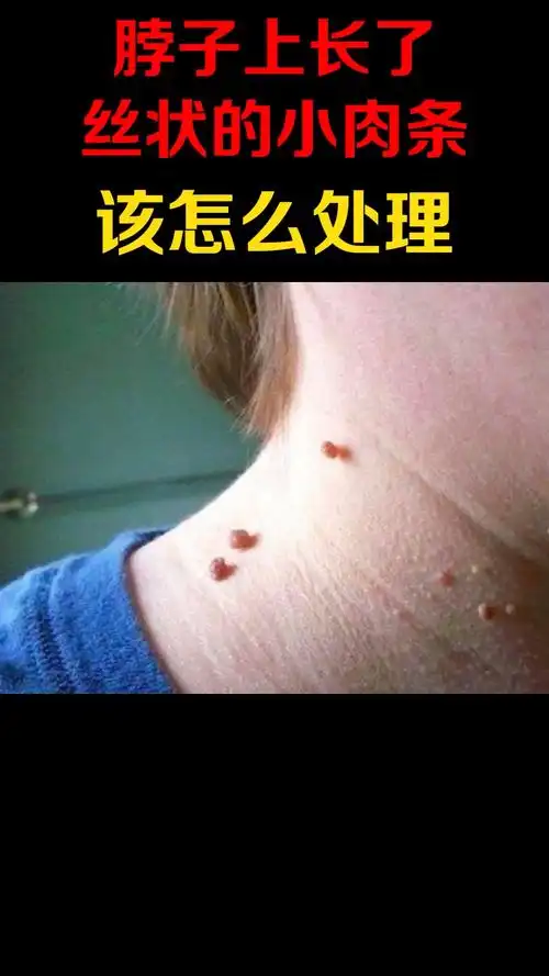 健康科普脖子上长了丝状的小肉条可能是丝状疣不要扣试试这样处理