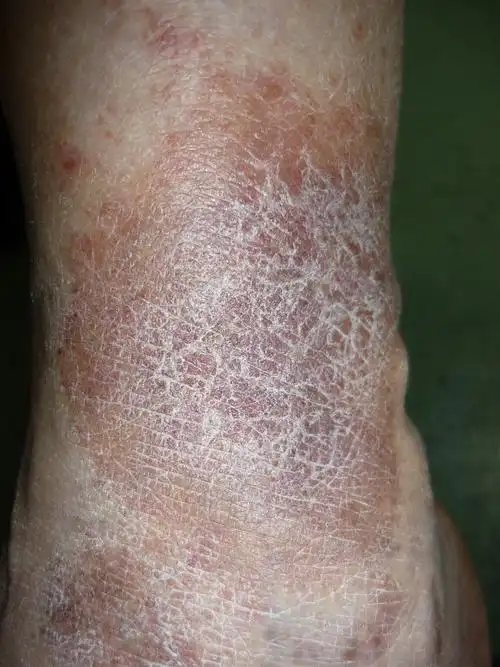 病例讨论——小腿红斑