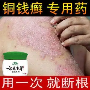 癣药膏外用皮肤老人