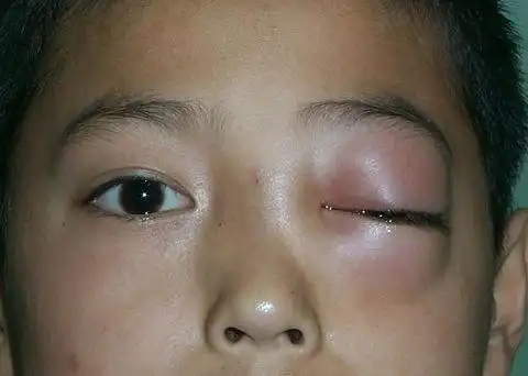 间歇性眼球突出症