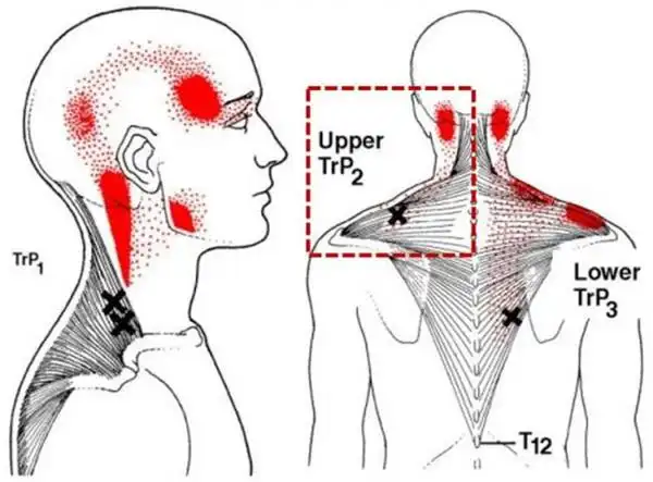 上斜方肌上的激痛点以及常见的疼痛散布范围