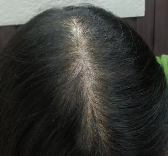 头发稀疏怎么办?