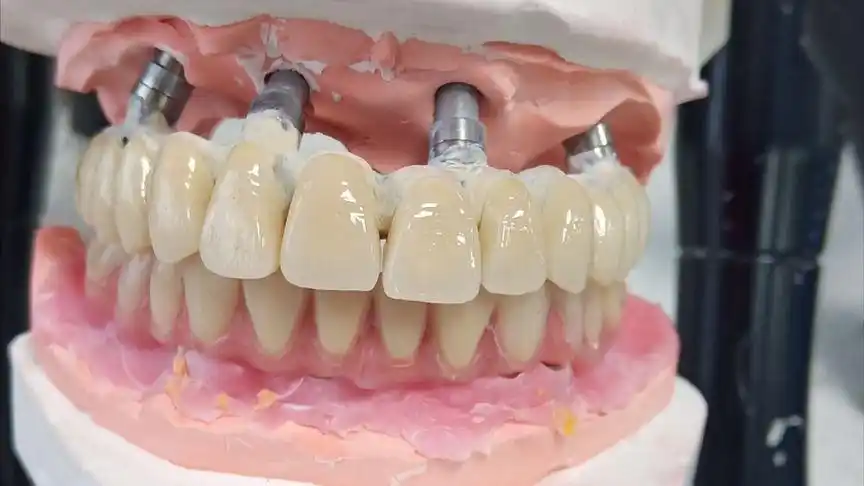 人类第三副牙齿之种植基台研磨休整