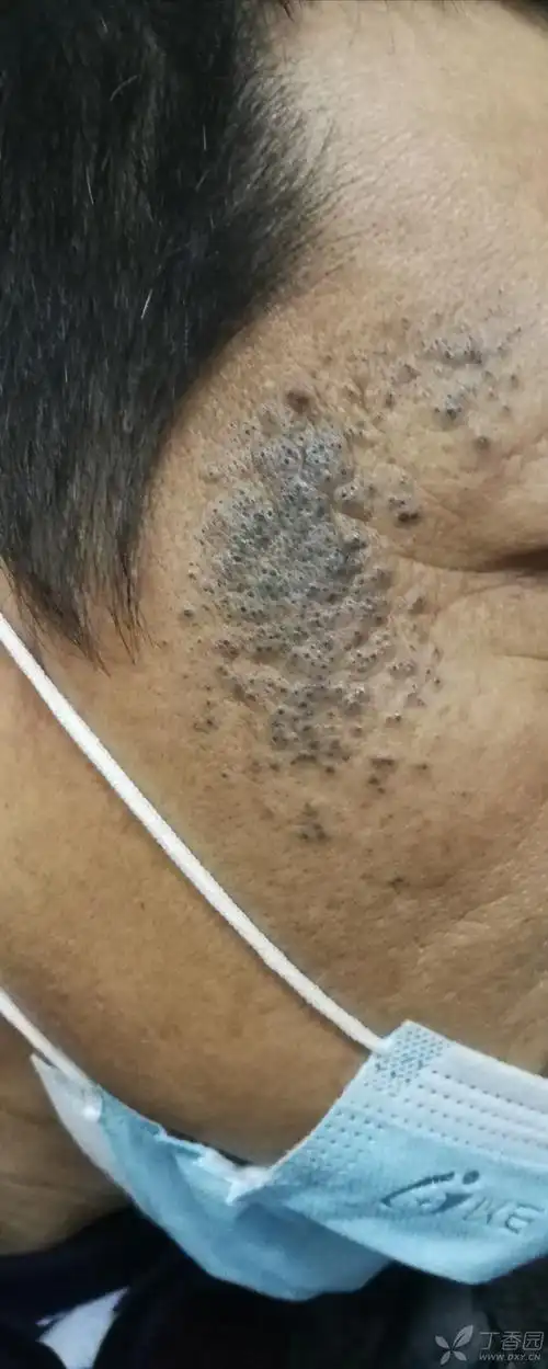 考虑黑头粉刺痣还是其他诊断