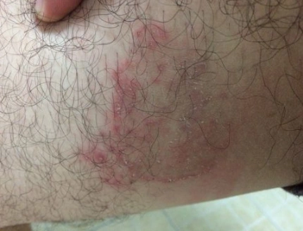 体癣图片_体癣症状表现图片大全_有来医生