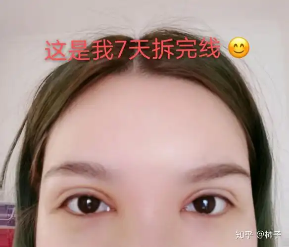 做欧式平行双眼皮超好看!全切双眼皮前必看95教你7天恢复自然