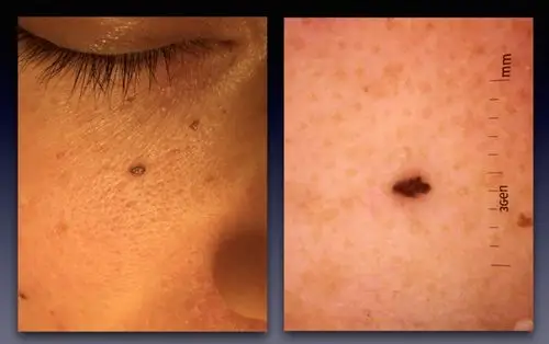 皮肤科医生的神魔武器:一面照妖镜是痣是瘤看得清