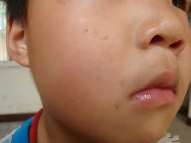 小孩面部长扁平疣图片
