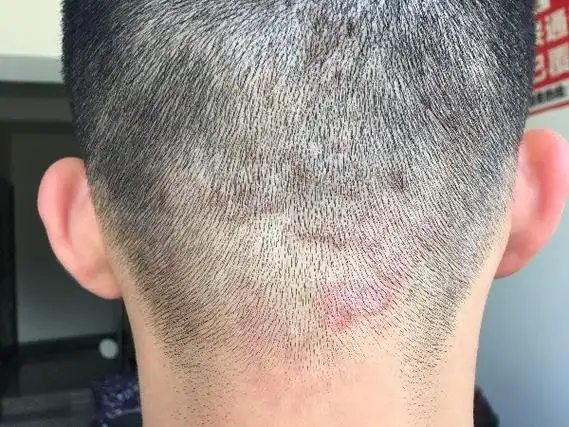 脂溢性皮炎的早期症状特征