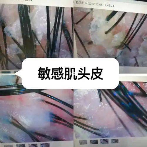 尝试各种洗发水|头皮敏感头屑