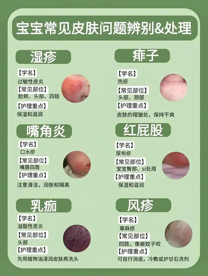 湿疹热疹如何区分?宝宝皮肤问题不要急!|||【湿疹】 宝宝湿 - 抖音