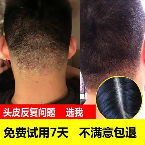 治头上长红疙瘩头皮长痘痘毛囊发炎专用药除螨癣藓头癣止痒洗发水