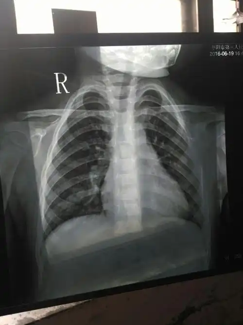 刚刚在医院给娃拍的肺部片子,医生帮我看看是不是肺炎